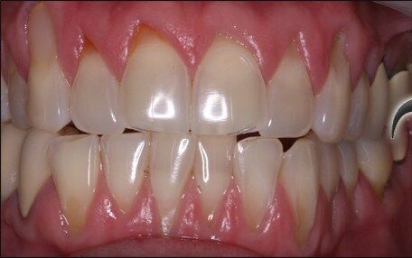 receding gums surgery before and after